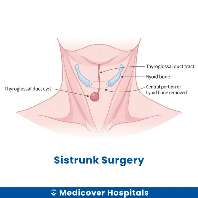 Sistrunk Surgery