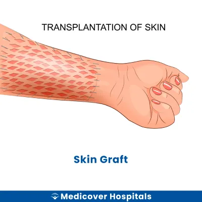Skin Graft