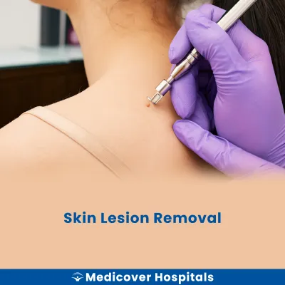 Skin Lesion Removal
