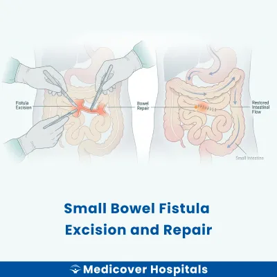 Small Bowel Fistula Excision and Repair