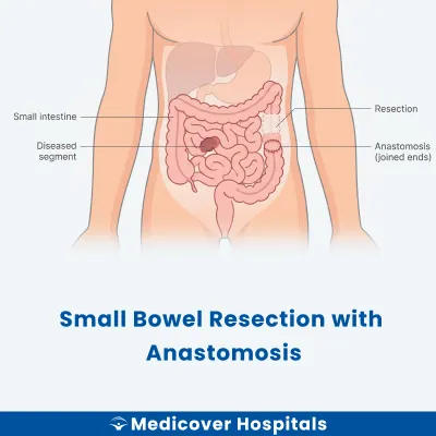 Small Bowel Resection With Anastomosis