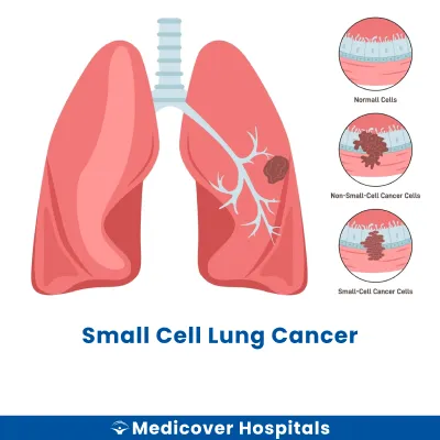 Small Cell Lung Cancer