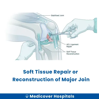 Soft Tissue Repair Or Reconstruction of Major Joint