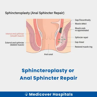 Sphincteroplasty Or Anal Sphincter Repair