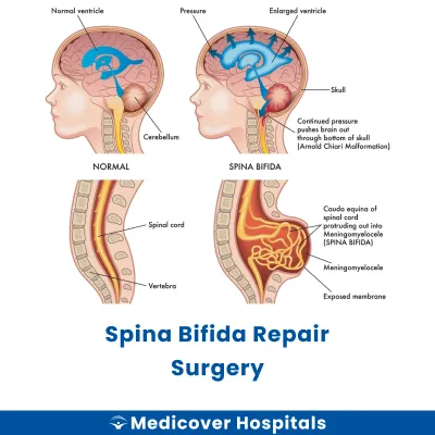 Spina Bifida Repair Surgery