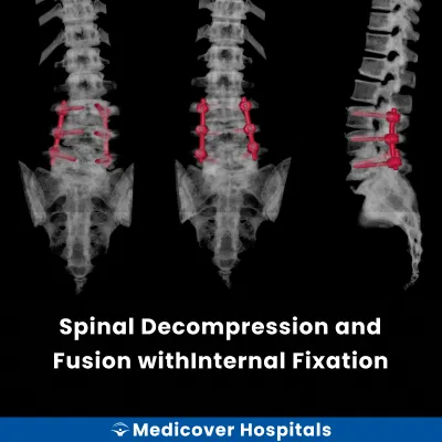 Spinal Decompression and Fusion With Internal Fixation