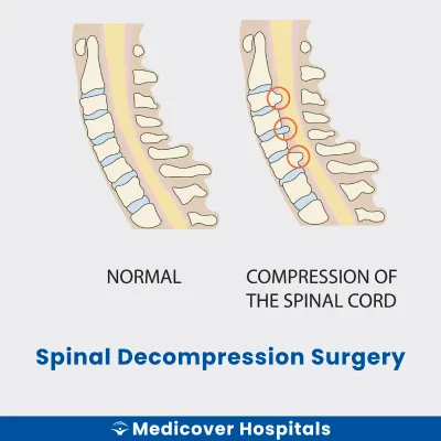 Spinal Decompression Surgery