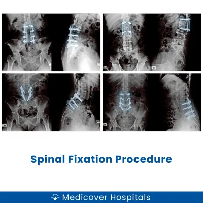 Spinal Fixation Procedure