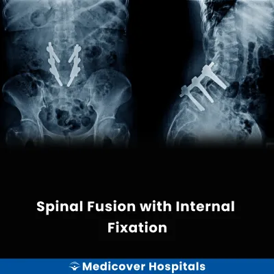 Spinal Fusion With Internal Fixation