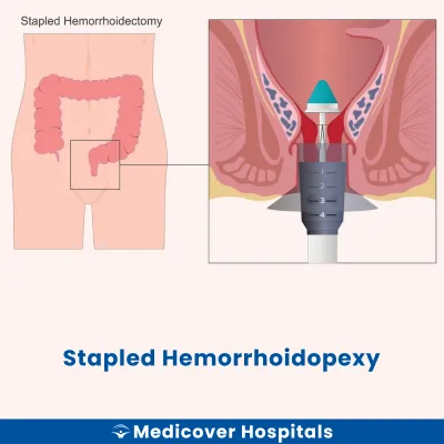 Stapled Hemorrhoidopexy