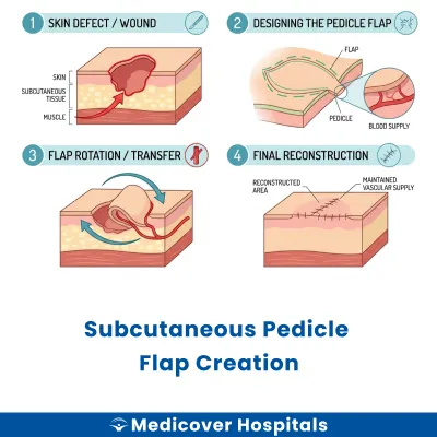 Subcutaneous Pedicle Flap Creation