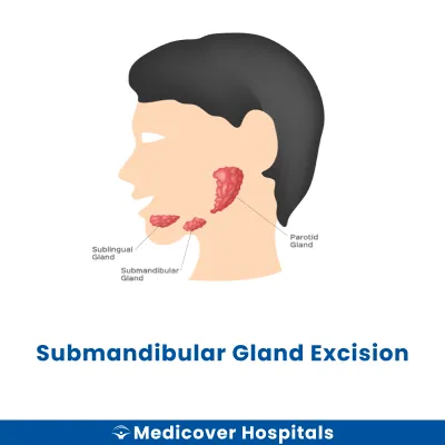 Submandibular Gland Excision