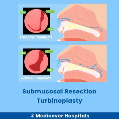 Submucosal Resection Turbinoplasty