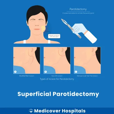 Superficial Parotidectomy
