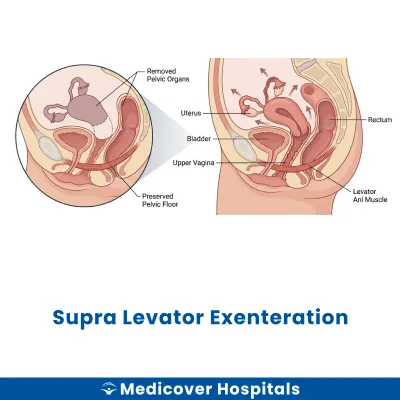 Supra Levator Exenteration