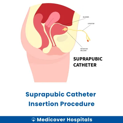 Suprapubic Catheter Insertion Procedure