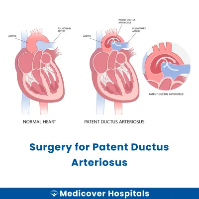 Surgery for Patent Ductus Arteriosus