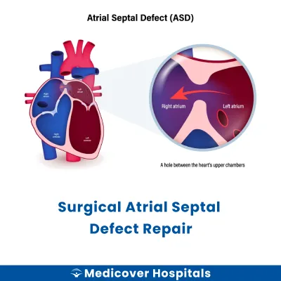 Surgical Atrial Septal Defect Repair