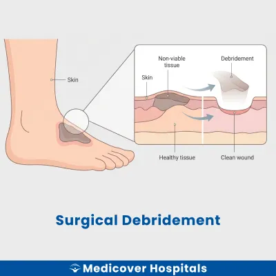 Surgical Debridement