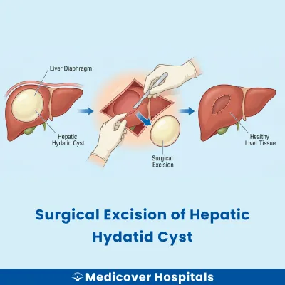 Surgical Excision of Hepatic Hydatid Cyst