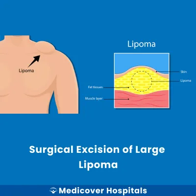 Surgical Excision of Large Lipoma