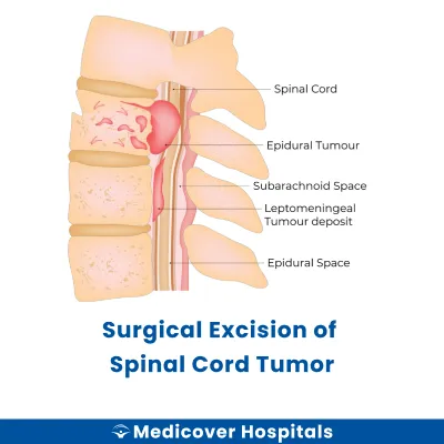 Surgical Excision of Spinal Cord Tumor