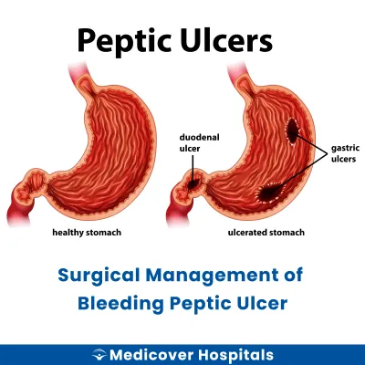 Surgical Management of Bleeding Peptic Ulcer