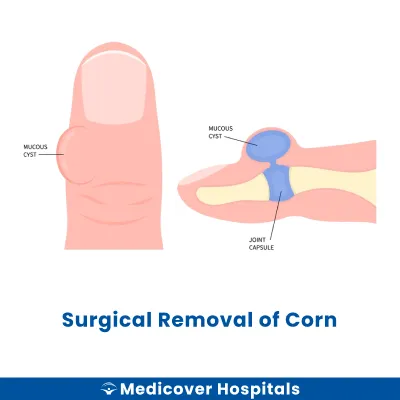 Surgical Removal of Corn