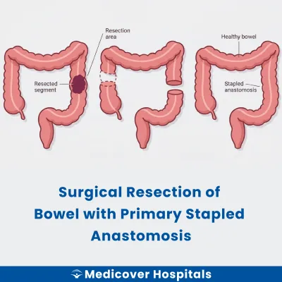 Surgical Resection of Bowel With Primary Stapled Anastomosis