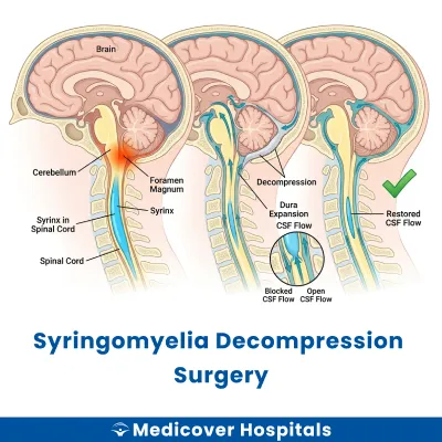 Syringomyelia Decompression Surgery