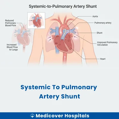 Systemic To Pulmonary Artery Shunt