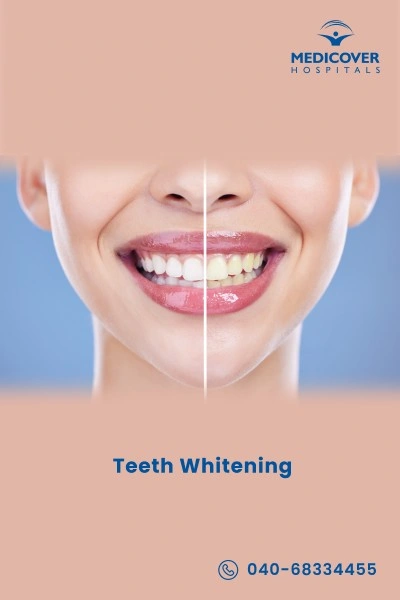 teeth-whitening