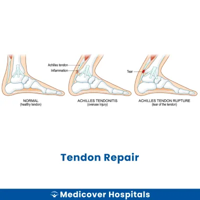 Tendon Repair