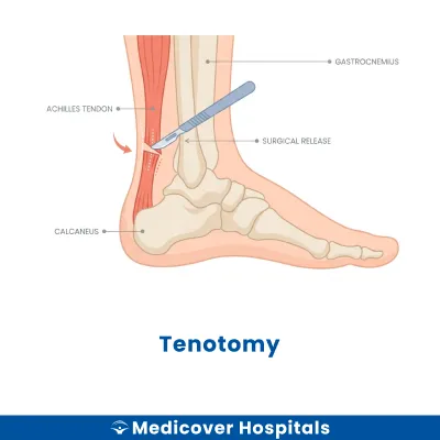 Tenotomy