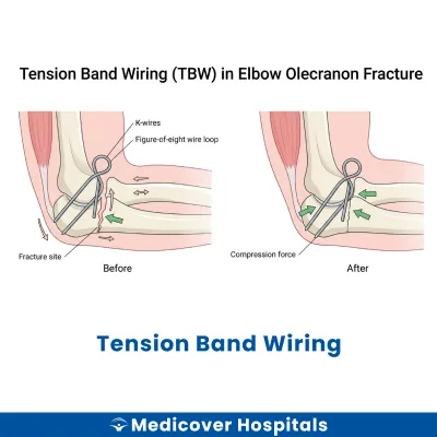 Tension Band Wiring