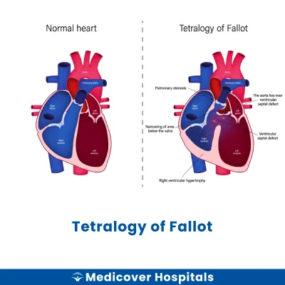 Tetralogy of Fallot