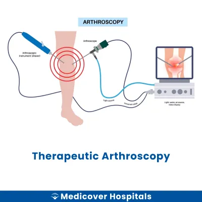 Therapeutic Arthroscopy