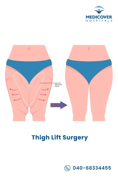thigh-lift