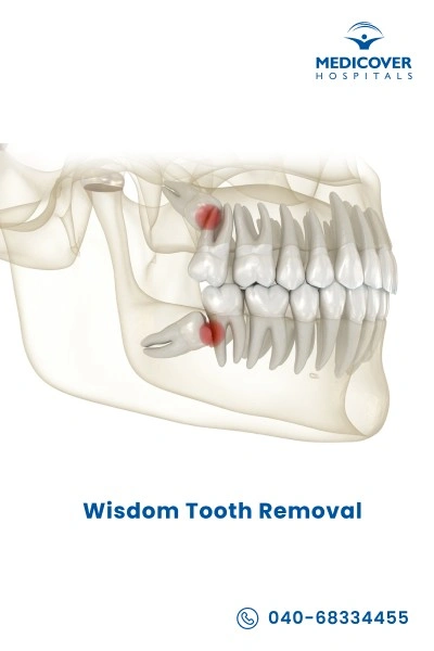 third-molars