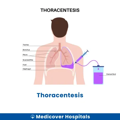 Thoracentesis