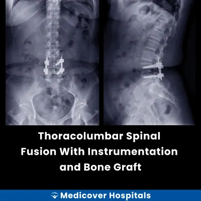 Thoracolumbar Spinal Fusion With Instrumentation and Bone Graft