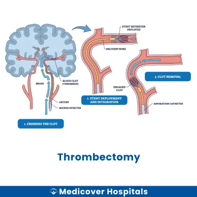 Thrombectomy