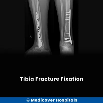 Tibia Fracture Fixation