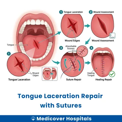 Tongue Laceration Repair With Sutures