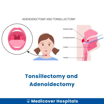Tonsillectomy and Adenoidectomy