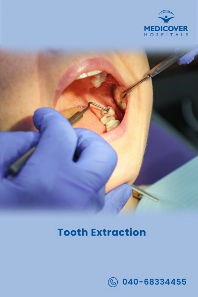 tooth-extraction