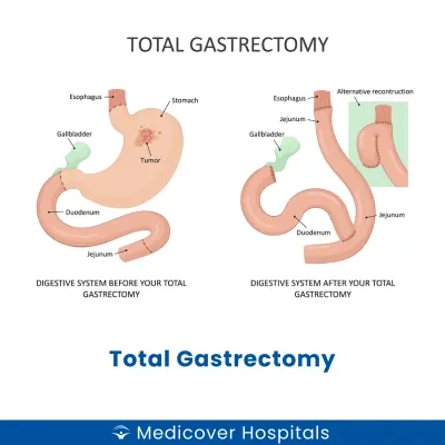 Total Gastrectomy