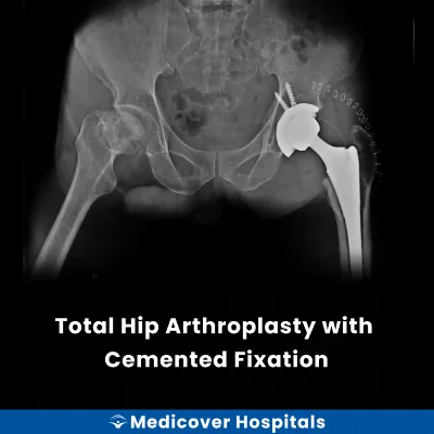 Total Hip Arthroplasty With Cemented Fixation