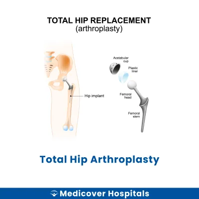 Total Hip Arthroplasty