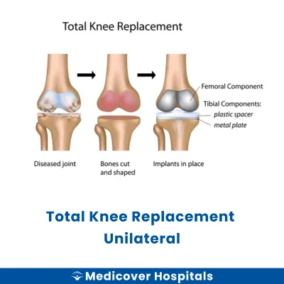 Total Knee Replacement Unilateral
